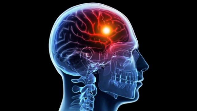 Stroke